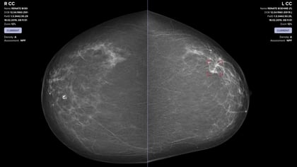 Doctors Using AI Catch Breast Cancer More Often Than Either Does Alone